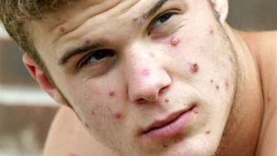 هاني الناظر: لم يتم رصد أي حالات مصابة بجدري القرود في مصر