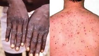 كندا تسجل 6 حالات جديدة بـ جدري القرود.. وبريطانيا: نرصد إصابات يوميًا