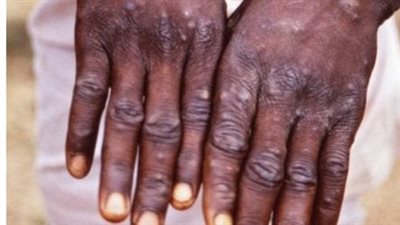 جنوب إفريقيا تحث مواطنيها على توخي اليقظة لمنع تفشي جدري القرود