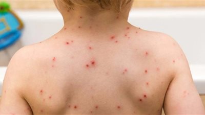 الحكومة: توفير 1350 كاشف حمض نووي ضمن إجراءات مواجهة جدري القرود