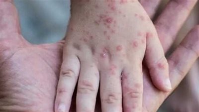 الاتحاد الأوروبي يطالب بإعداد خطة تطعيم ضد جدري القرود