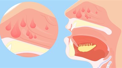 بالأطعمة الخفيفة والمرق..  كيف تعالج التغذية السليمة مرض اللحمية
