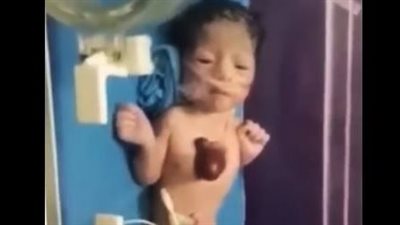 ولادة طفل بقلب خارج الصدر.. وعميد معهد القلب السابق: حالة نادرة تصيب الذكور أكثر من الإناث 