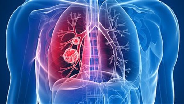 الانسداد الرئوي