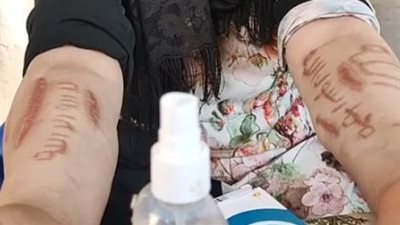 سيدة تستغيث من ظهور لفظ الجلالة مكتوب على ذراعيها: الدكاترة خايفين مني وعاوزه حد يساعدني | بث مباشر