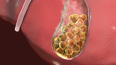 تكوين حصوات الكلى.. ماذا تفعل مستويات حمض البوليك المرتفعة في الجسم؟