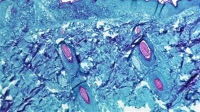 أستراليا تسجل الحالة السادسة من جدري القرود