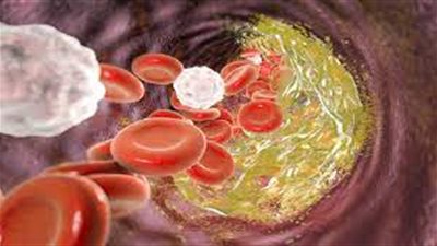 تعرف على التأثيرات السلبية لارتفاع مستويات الكولسترول بالدم 