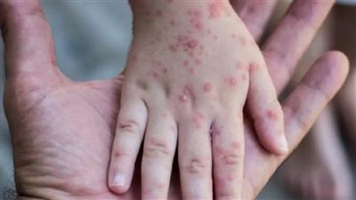 غضب وابتلاء من الله أم ماذا؟.. داعية إسلامي يحسم الجدل حول جدري القرود