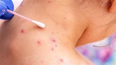 نيجيريا تسجل 41 إصابة مؤكدة بفيروس جدري القرود