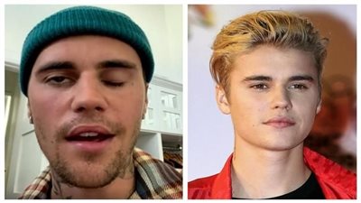 لا أستطيع التبسم وغلق عيني.. تفاصيل إصابة المغني جاستن بيبر بشلل في الوجه | فيديو