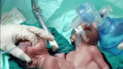 مستشفى صحة المرأة بأسيوط تنجح في إجراء عملية ولادة قيصرية لتوأم ملتصق |صور