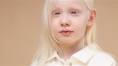 في اليوم العالمي للمهق.. تعرف على أسباب الاحتفال بالمرض