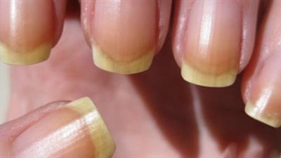 5 أعراض تظهر بالأظافر تدل على إصابتك بالسكري