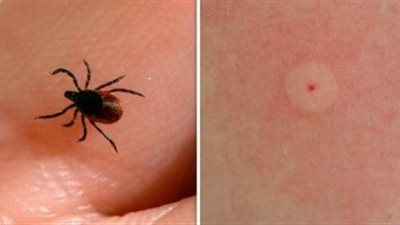 دراسة:10% من مواطني أمريكيا يعانون من مرض لايم