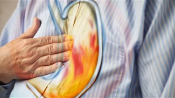 الحموضة - تعبيرية