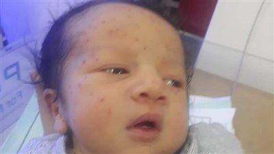 مصدر طبي يكشف تفاصيل الحالة الصحية لطفل حديث الولادة عُثر عليه بالمنوفية