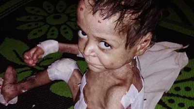 ابني هدومه بتتحرق وجسمه بيطلع منه حشرات.. والدة طفل تستغيث بالمسؤولين لعلاج نجلها من مرض جلدي نادر