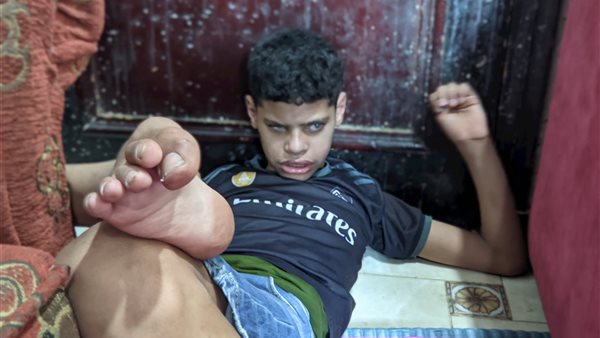 الطفل المصاب بالمنوفية