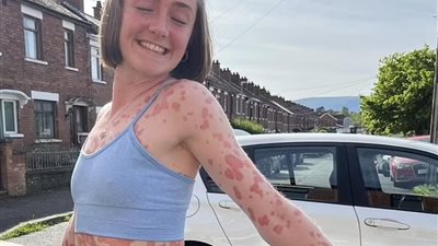 أيرلندية مصابة بمرض نادر يجعلها تتحول في غضون أسبوع لجسم الفهد