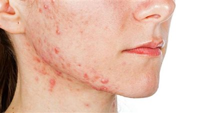 5 طرق للوقاية من حب الشباب في فصل الصيف