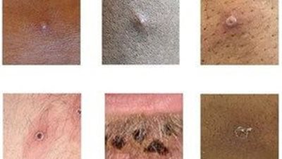 أعراض فيروس جدري القرود تختلف عن الأنواع السابقة | دراسة