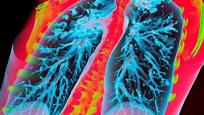 إطلاق العلاج الأول لمرضى الرئة الذين يعانون من مشاكل التنفس في بريطانيا