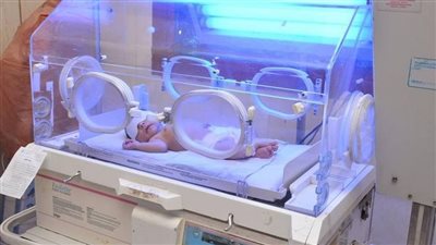 عيناها مقلوبتان وأطرافها أشبه بالمخالب.. تطورات الحالة الصحية لطفلة الشمع في الغربية