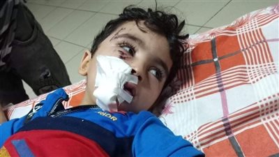 عقره في الوجه.. كلب ضال يصيب طفلا بإصابات خطيرة بالمنوفية