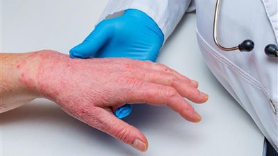 ولاية أسترالية جديدة تسجل أول إصابة بفيروس جدري القرود