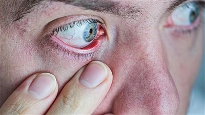 في ظل الأتربة والرمال.. القطرات والكمدات أبرز النصائح لضمان صحة العين 