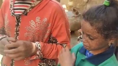 طفلتان مصابتان بمرض نادر في الوجه بسوهاج.. وأسرتهما: تحملنا كل آلام التنمر