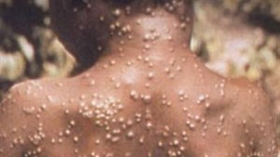 علماء أوبئة: انتقال فيروس جدري القرود الحالي يدل على تحوره