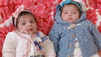 وفاة الطفلة سارة إبراهيم إحدى توأم مرض الضمور العضلي قبل حصولها على الحقنة الأغلى في العالم