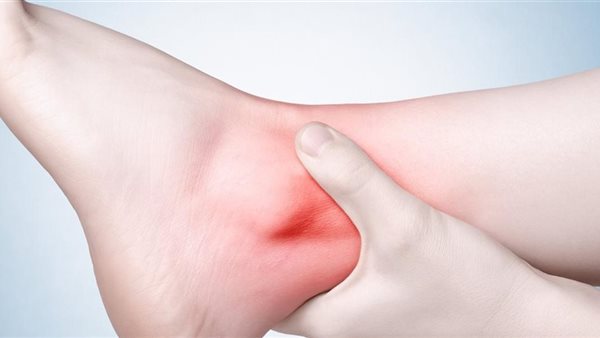 تورم الكاحل