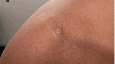 طفل هولندي عائد من تركيا.. تسجيل أول إصابة بجدري القرود لدى الأطفال