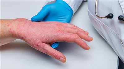 إصابات جدري القرود تتضاعف 3 مرات في ولاية فلوريدا الأمريكية خلال الشهر الجاري