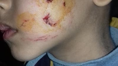 تكرار الهجوم على المارة.. الكلاب الضالة تعقر طفلين واستغاثات من أهالي كفر شكر (صور)