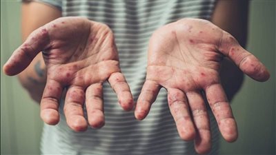 الهند تعثر على حالتين مصابتين بفيروس جدري القرود لعائدين من الإمارات