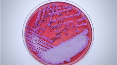 تتسبب في وفاة 50% من المصابين.. اكتشاف بكتيريا مميتة تشبه السل بأمريكا