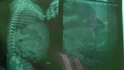 واقعة نادرة | مولودة تحمل جنينًا في بطنها بالدقهلية.. وطبيب: دي ثاني حالة في مصر