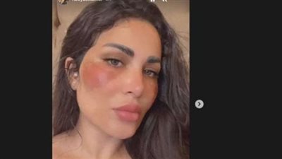 طليقة أحمد الفيشاوي تكشف حقيقة تعرضها للحرق