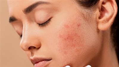 أبرزها العامل الوراثي.. تعرف على أسباب الكلف