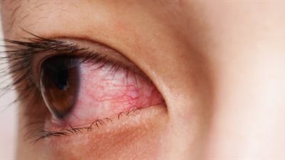 طفرة علمية جديدة.. باحثون يتمكنون من علاج العمى نهائيًا