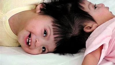 الإفتاء: زواج التوأم الملتصق جائز.. وهذه طريقة ممارسة حياتهما الزوجية 