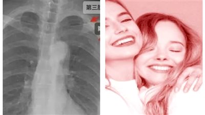 بسبب حضن.. فتاة صينية تكسر ضلوع صديقتها وتُعرض للمحاكمة