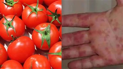 بعد تسجيل 100 إصابة بالهند.. مخاطر وأعراض حمى الطماطم ونصائح لتجنب المرض