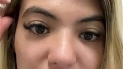 نامت تحت أشعة الشمس.. صور توثق احتراق جبهة سيدة بريطانية بسبب شدة الحرارة  