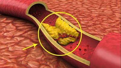 الرعاية الصحية: علاج الانسداد المزمن للشرايين التاجية عن طريق cto بالتأمين الشامل  