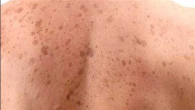 هيئة الدواء توضح طرق الوقاية من الإصابة بالتينيا الجلدية